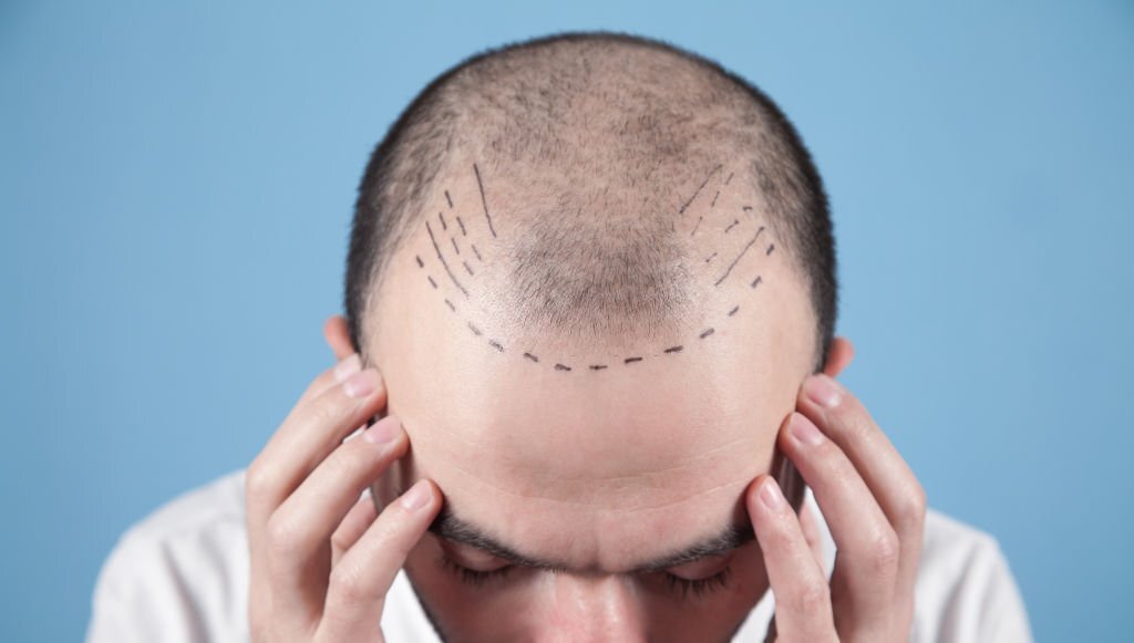 Saç Ekimi Fethiye Saç köklerinde oluşabilen bir çok hasar saçın dökülmesinde etkendir.