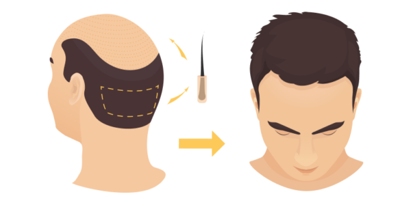FUE Hair Transplant Fethiye