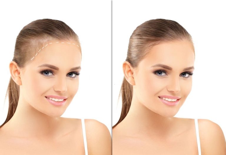 Female Hair Transplantation