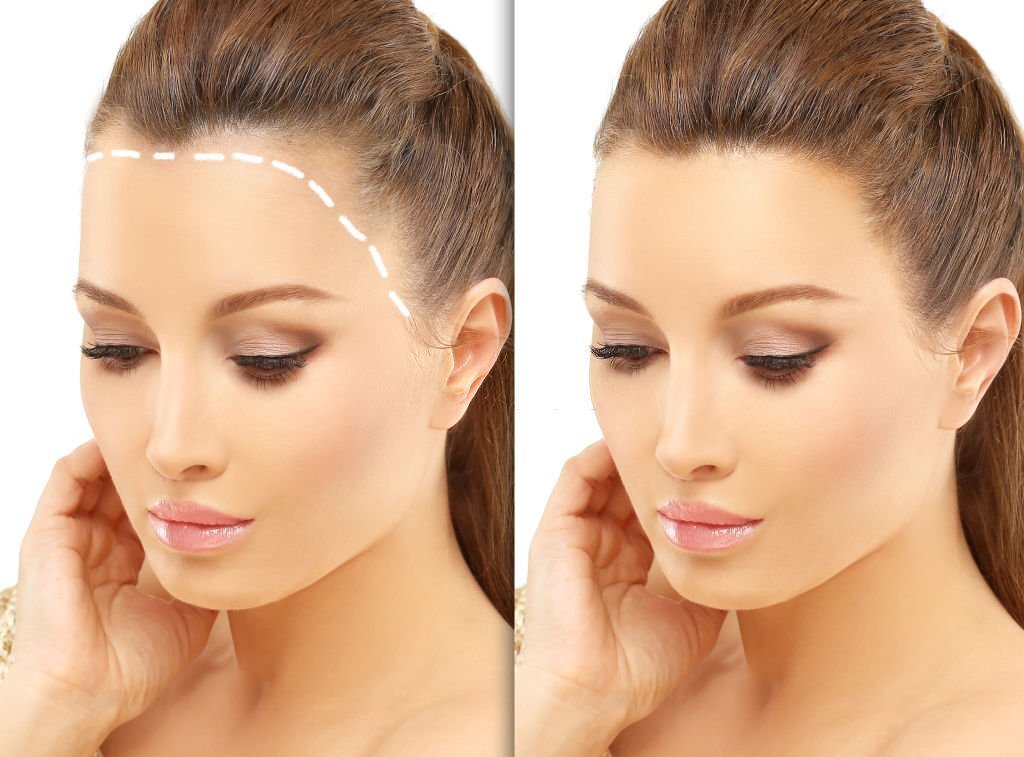 Female Hair Transplantation